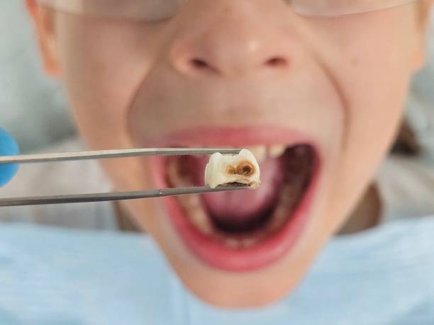 Best Emergency Dental Care for Broken or Chipped Teeth in Portland, TX