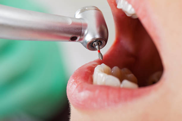 Best Emergency Treatment for Dental Infections or Abscesses in Portland, TX
